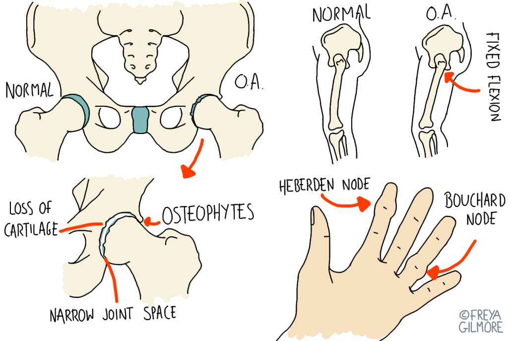 Osteoarthritis in the hip and hand