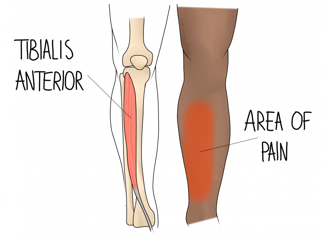 Sports injuries: shin splints