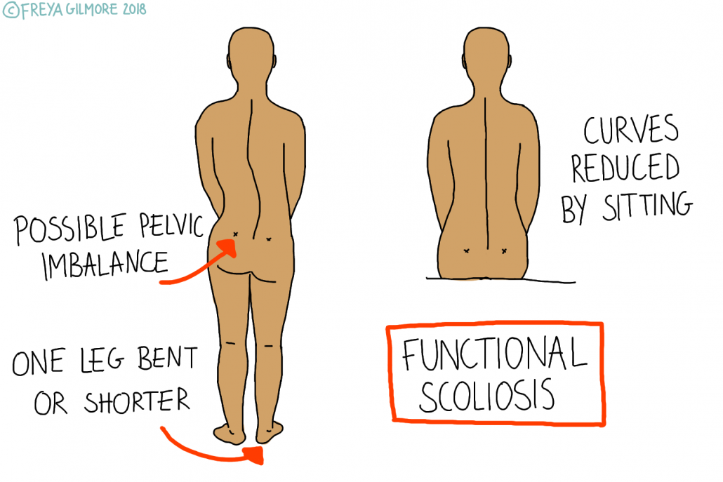 Functional scoliosis
