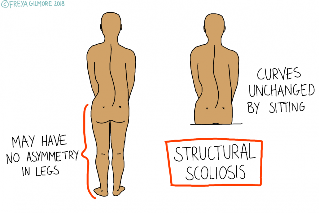 Structural scoliosis