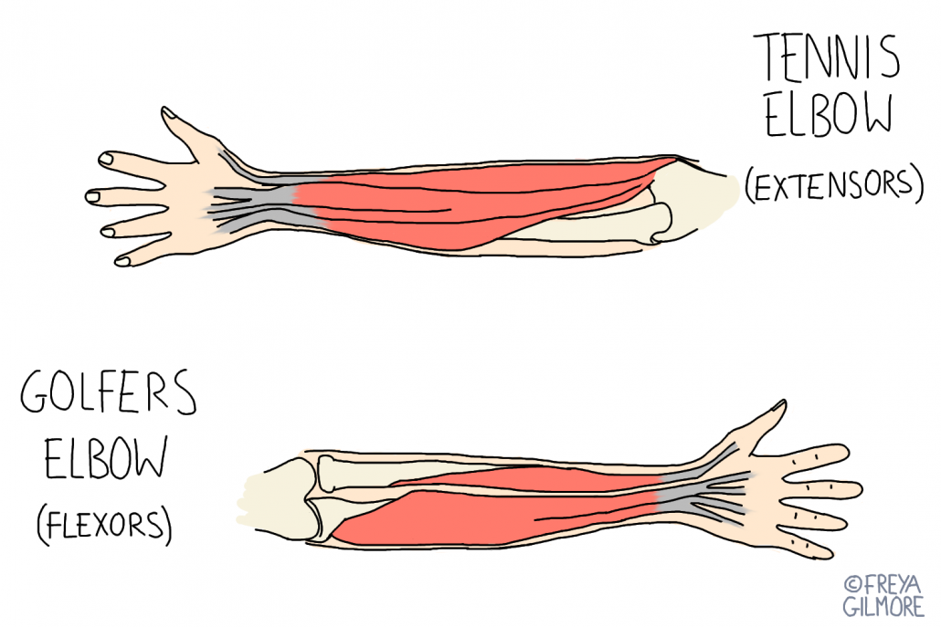 Tennis elbow and golfers elbow
