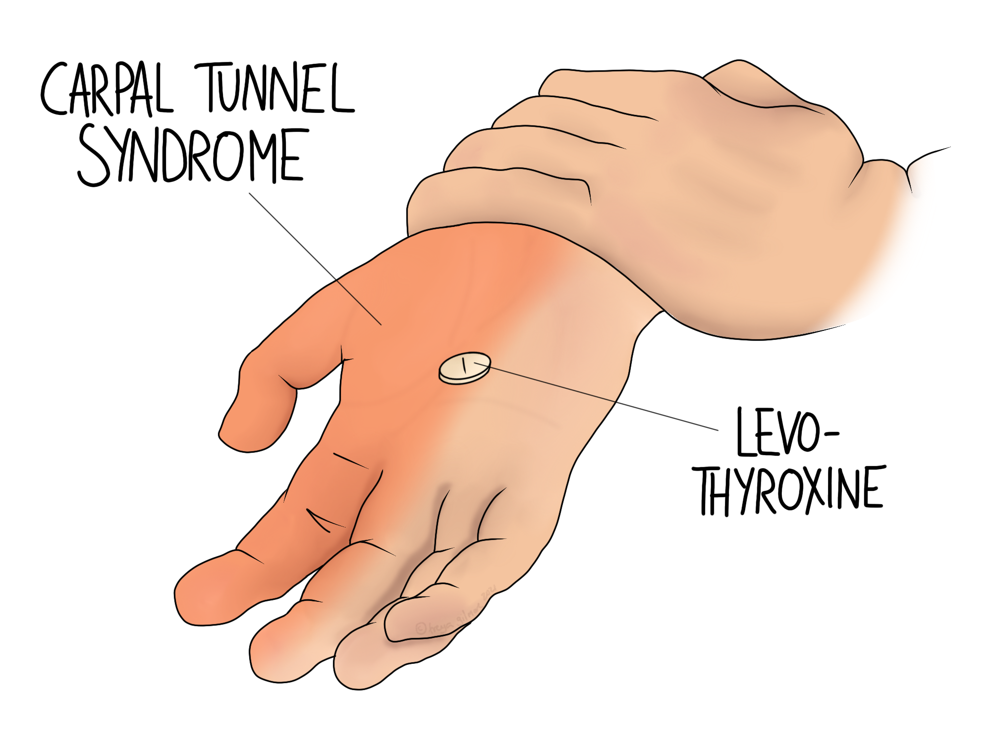 What is Carpal Tunnel Syndrome and How Does it Develop? - Osteopathy